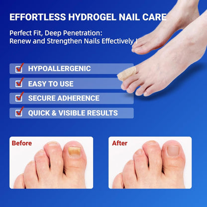 Fungal Nail Patches