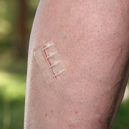 Everlit Wound Closure Kit – 2 Pcs, Suture-Free Strips